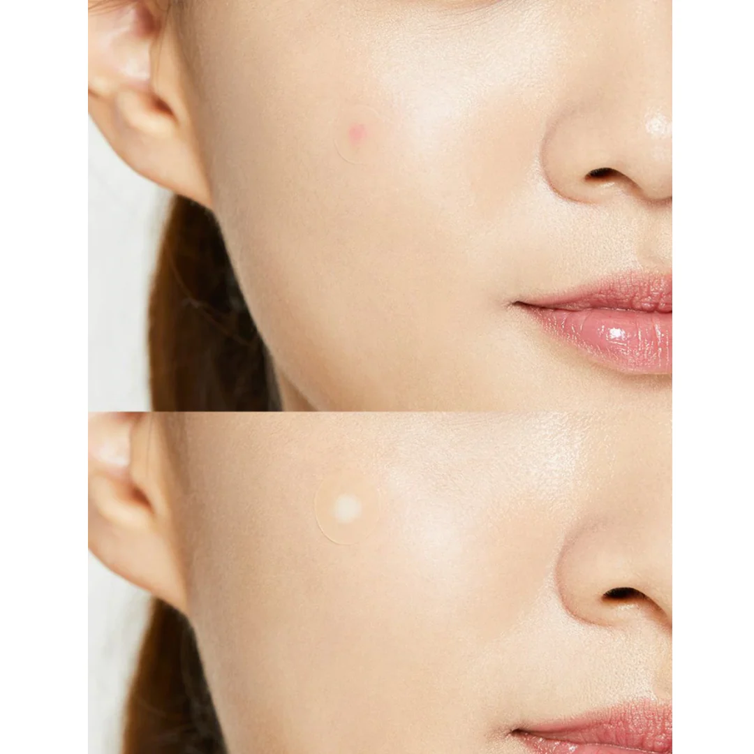 Acne Pimple Master Patches [24 Patches] - Image 2